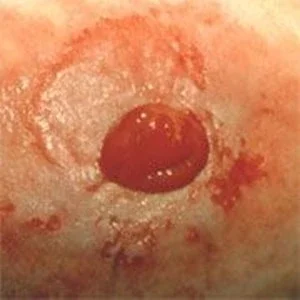 Irriteret peristomale hud