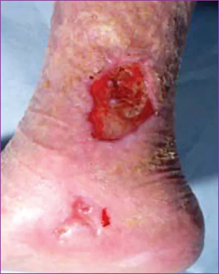 un primo piano di una ferita