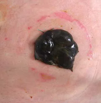 ピンク色の表面に黒い塊