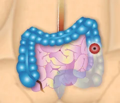 Child descending colostomy