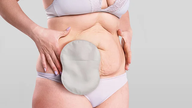 woman wearing an Esteem Body™ stoma pouch standing